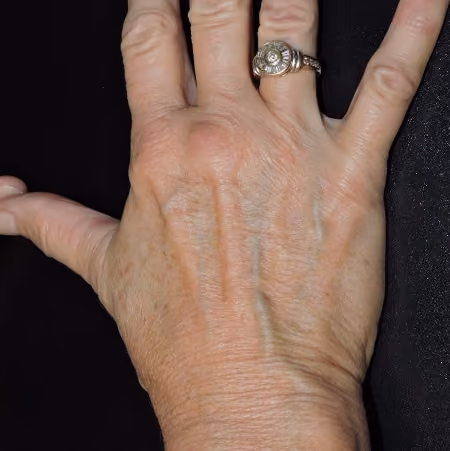 Hand Rejuvenation before and after, case 2131 - Cool Springs Plastic Surgery