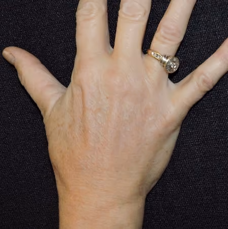 Hand Rejuvenation before and after, case 2131 - Cool Springs Plastic Surgery