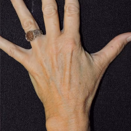 Hand Rejuvenation before and after, case 2131 - Cool Springs Plastic Surgery