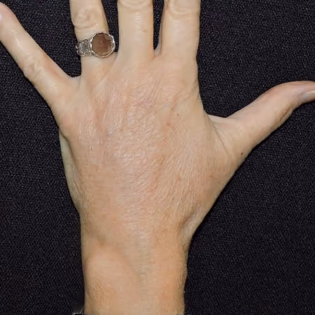 Hand Rejuvenation before and after, case 2131 - Cool Springs Plastic Surgery