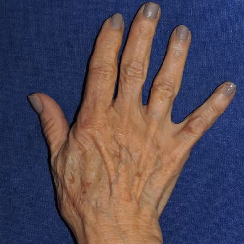Hand Rejuvenation before and after, case 5671 - Cool Springs Plastic Surgery