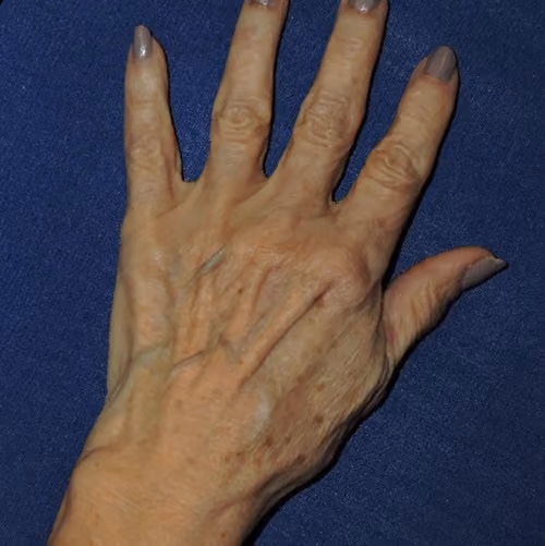 Hand Rejuvenation before and after, case 5671 - Cool Springs Plastic Surgery
