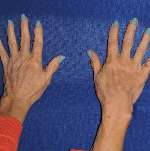 Hand Rejuvenation before and after, case 5671 - Cool Springs Plastic Surgery
