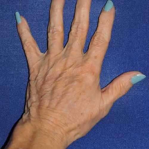 Hand Rejuvenation before and after, case 5671 - Cool Springs Plastic Surgery