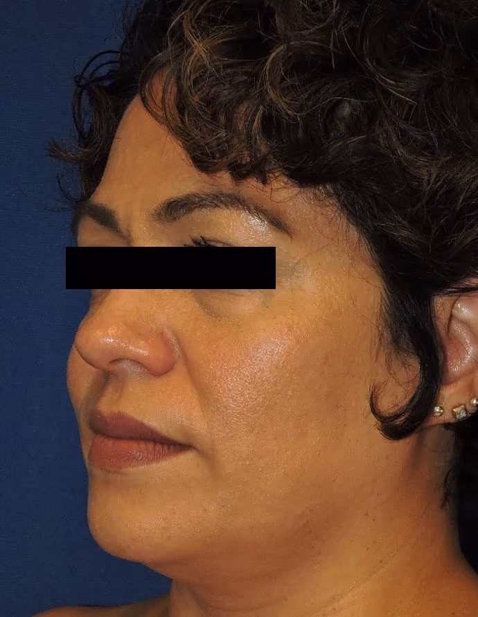 Facial Fat Grafting before and after, case 13307 - Cool Springs Plastic Surgery