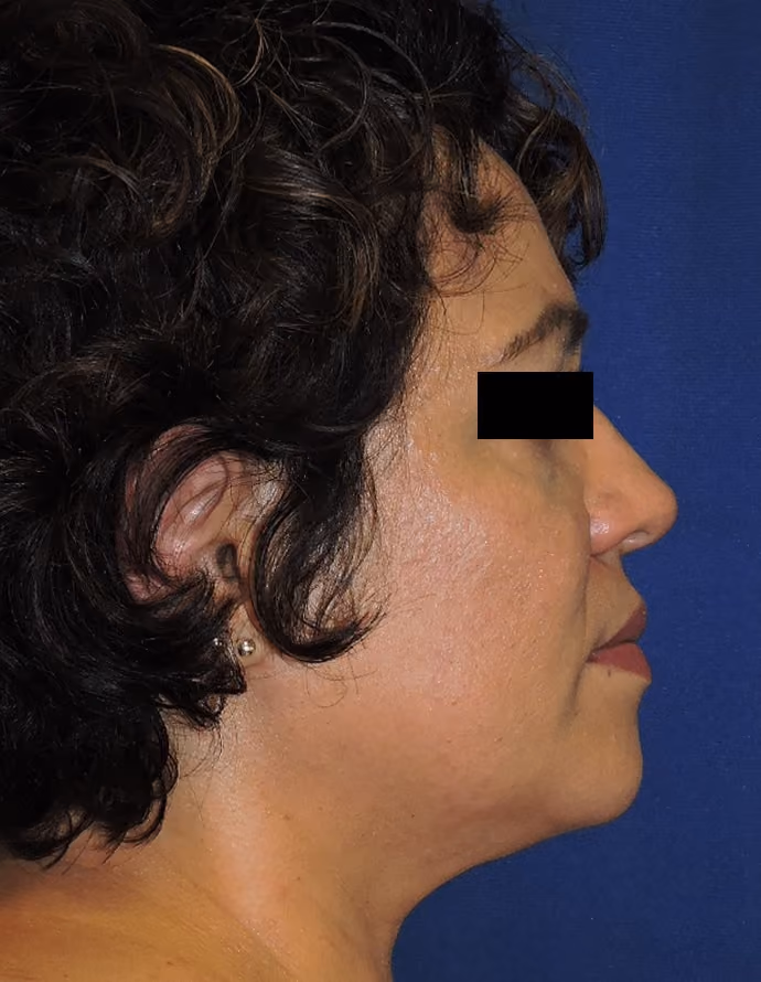 Facial Fat Grafting before and after, case 13307 - Cool Springs Plastic Surgery