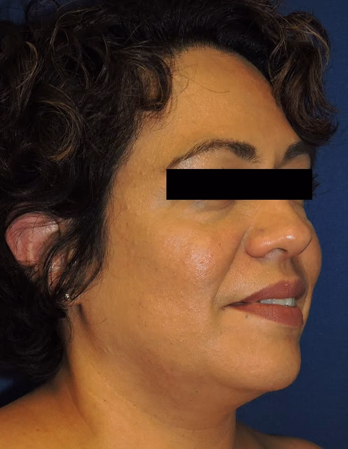 Facial Fat Grafting before and after, case 13307 - Cool Springs Plastic Surgery