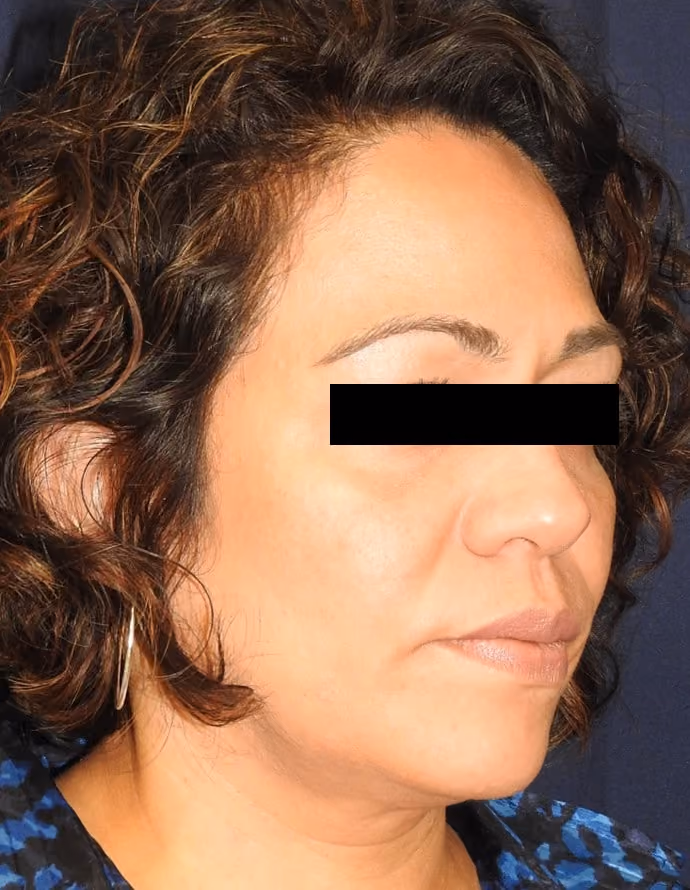 Facial Fat Grafting before and after, case 13307 - Cool Springs Plastic Surgery