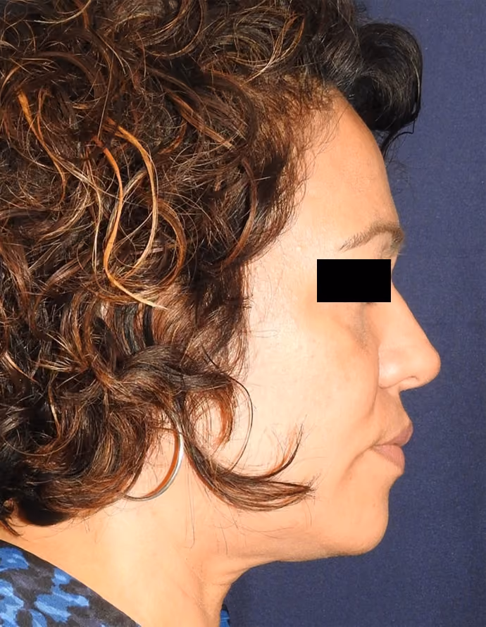 Facial Fat Grafting before and after, case 13307 - Cool Springs Plastic Surgery