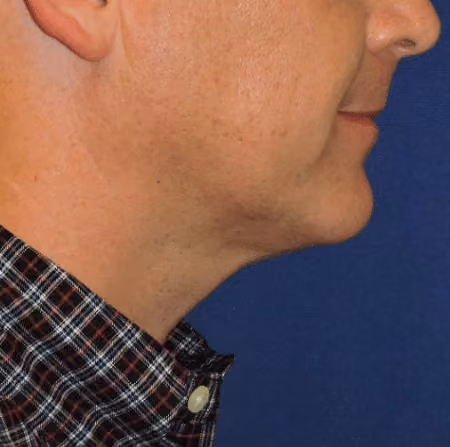 Chin + Neck Liposuction before and after, case 2151 - Cool Springs Plastic Surgery