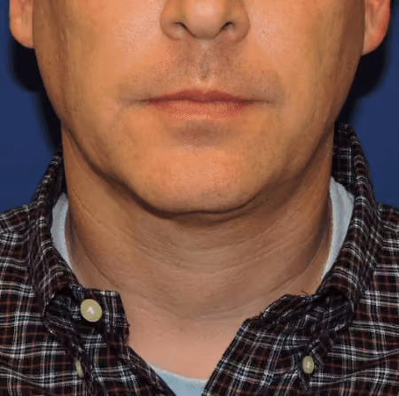 Chin + Neck Liposuction before and after, case 2151 - Cool Springs Plastic Surgery