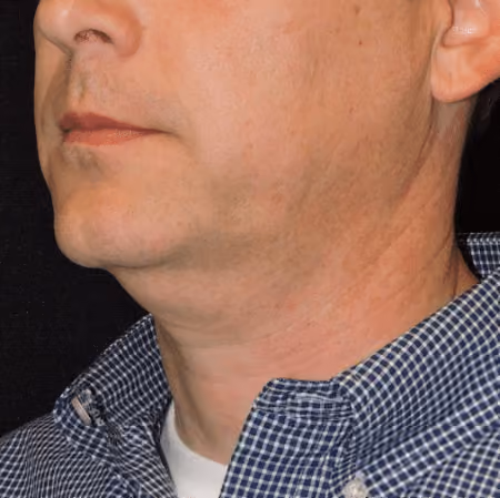 Chin + Neck Liposuction before and after, case 2151 - Cool Springs Plastic Surgery