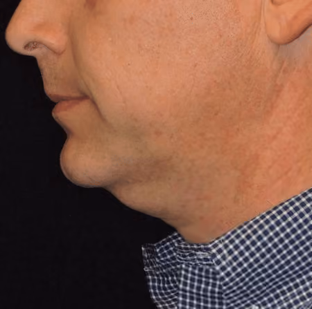 Chin + Neck Liposuction before and after, case 2151 - Cool Springs Plastic Surgery