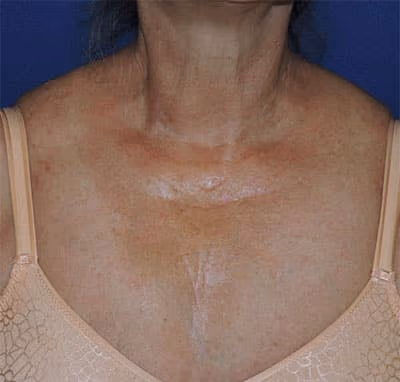 Halo before and after, case 7804 - Cool Springs Plastic Surgery