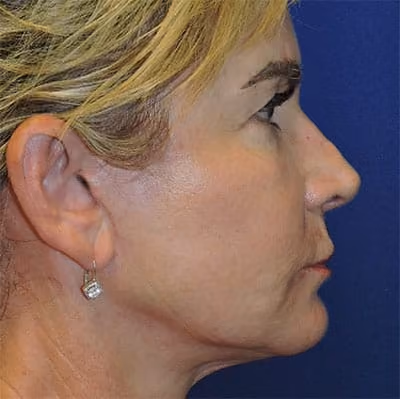 Halo before and after, case 7804 - Cool Springs Plastic Surgery