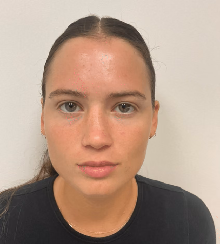 Botox before and after, case 58 - Cool Springs Plastic Surgery