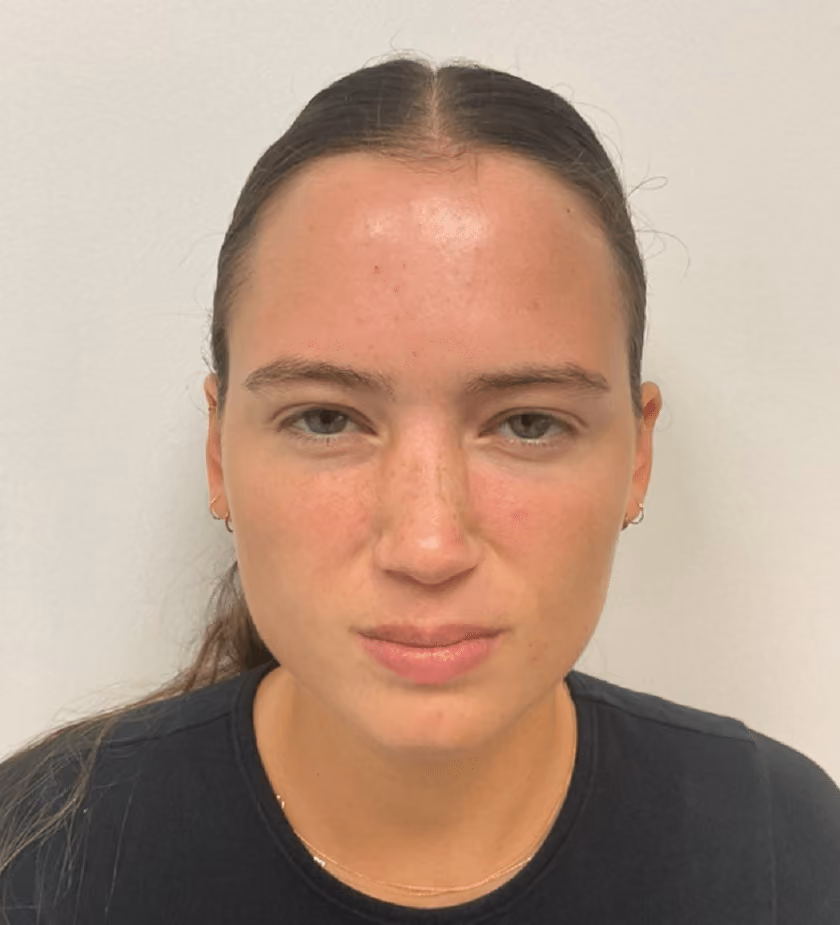 Botox before and after, case 58 - Cool Springs Plastic Surgery