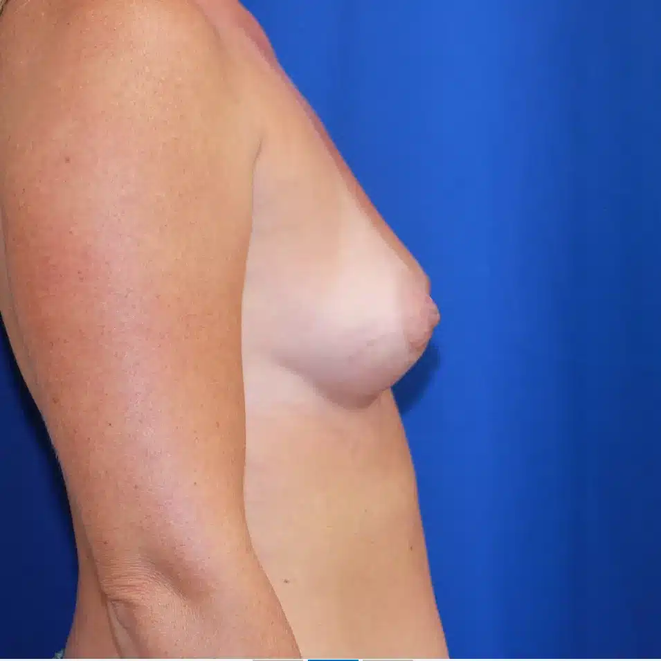 Breast Augmentation before and after, Dr. Sarosiek, case 15283 - Cool Springs Plastic Surgery
