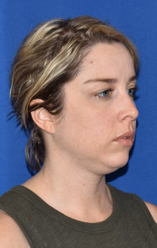 Liposuction before and after, Dr. Moore, case 1733 - Cool Springs Plastic Surgery