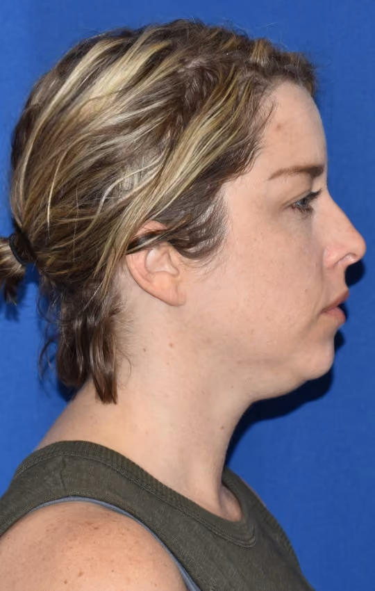 Liposuction before and after, Dr. Moore, case 1733 - Cool Springs Plastic Surgery