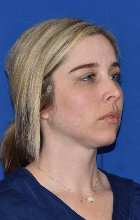 Liposuction before and after, Dr. Moore, case 1733 - Cool Springs Plastic Surgery