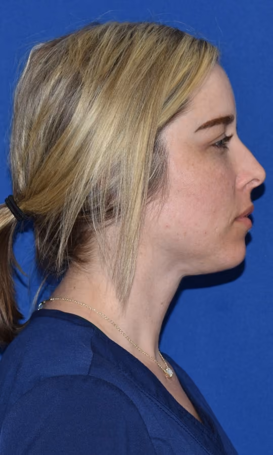 Liposuction before and after, Dr. Moore, case 1733 - Cool Springs Plastic Surgery