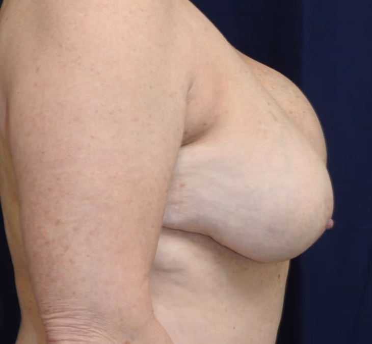 Breast Implant Revision before and after, case 3103 - Cool Springs Plastic Surgery