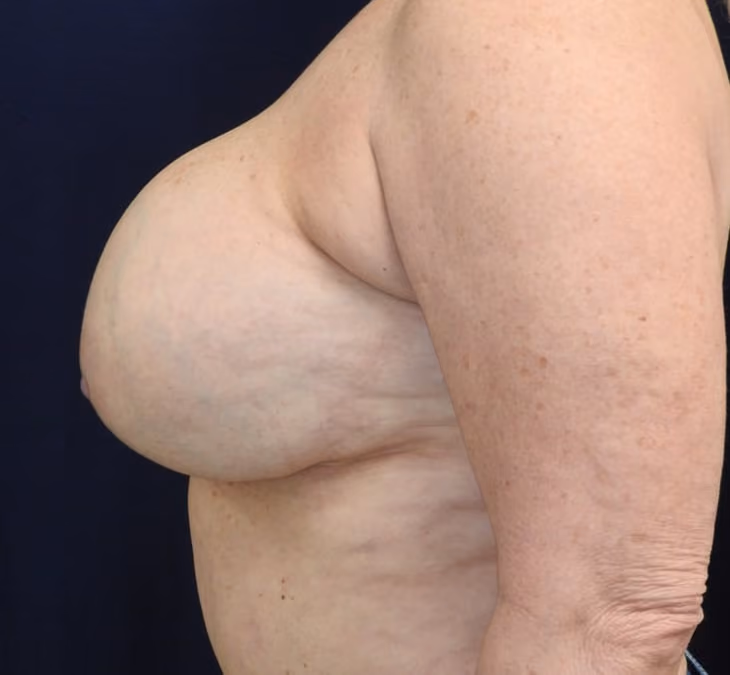Breast Implant Revision before and after, case 3103 - Cool Springs Plastic Surgery