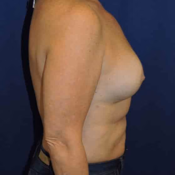 Breast Implant Revision before and after, case 2691 - Cool Springs Plastic Surgery