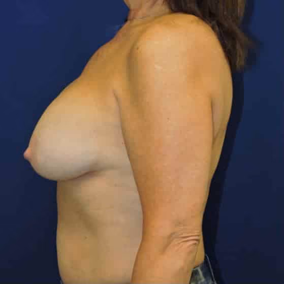 Breast Implant Revision before and after, case 2691 - Cool Springs Plastic Surgery