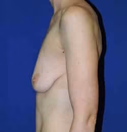 Breast Lift + Augmentation before and after, case 1600 - Cool Springs Plastic Surgery