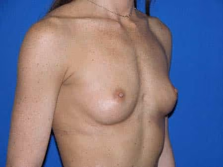 Breast Augmentation before and after, case 1590 - Cool Springs Plastic Surgery