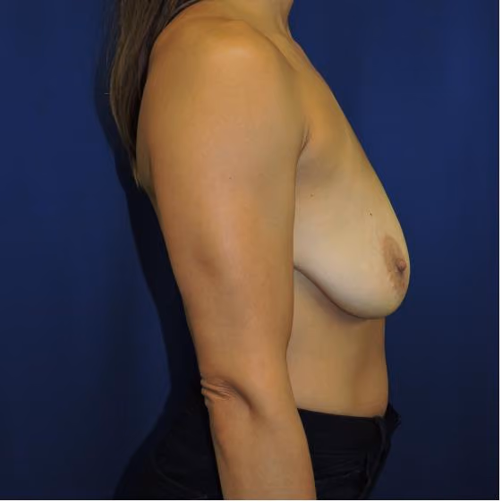 Breast Lift + Augmentation before and after, case 1551 - Cool Springs Plastic Surgery