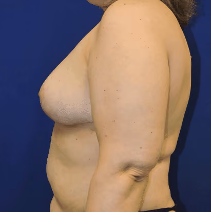 Breast Reduction before and after, case 1523 - Cool Springs Plastic Surgery