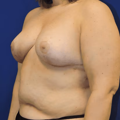 Breast Reduction before and after, case 1523 - Cool Springs Plastic Surgery