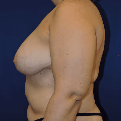 Breast Reduction before and after, case 1523 - Cool Springs Plastic Surgery