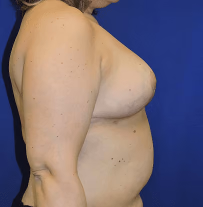 Breast Reduction before and after, case 1523 - Cool Springs Plastic Surgery