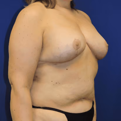 Breast Reduction before and after, case 1523 - Cool Springs Plastic Surgery