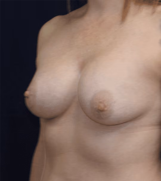 Breast Lift + Augmentation before and after, case 1500 - Cool Springs Plastic Surgery