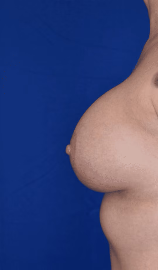 Breast Lift + Augmentation before and after, case 1500 - Cool Springs Plastic Surgery
