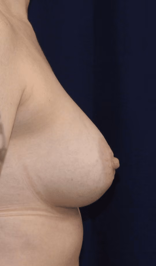 Breast Lift + Augmentation before and after, case 1500 - Cool Springs Plastic Surgery