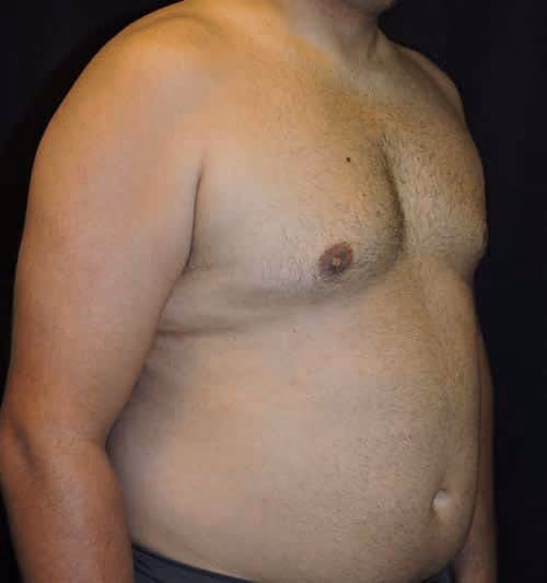Gynecomastia before and after, case 1436 - Cool Springs Plastic Surgery