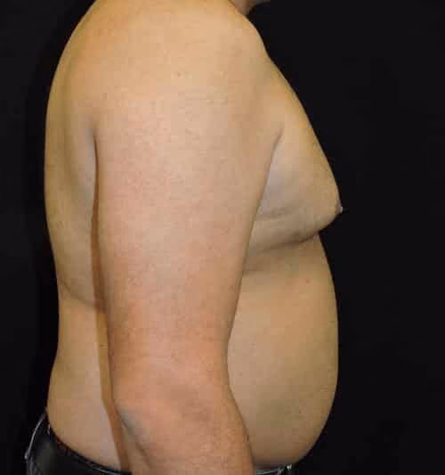 Gynecomastia before and after, case 1436 - Cool Springs Plastic Surgery