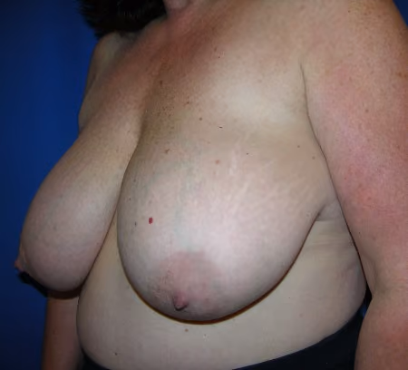 Breast Reduction before and after, case 1411 - Cool Springs Plastic Surgery
