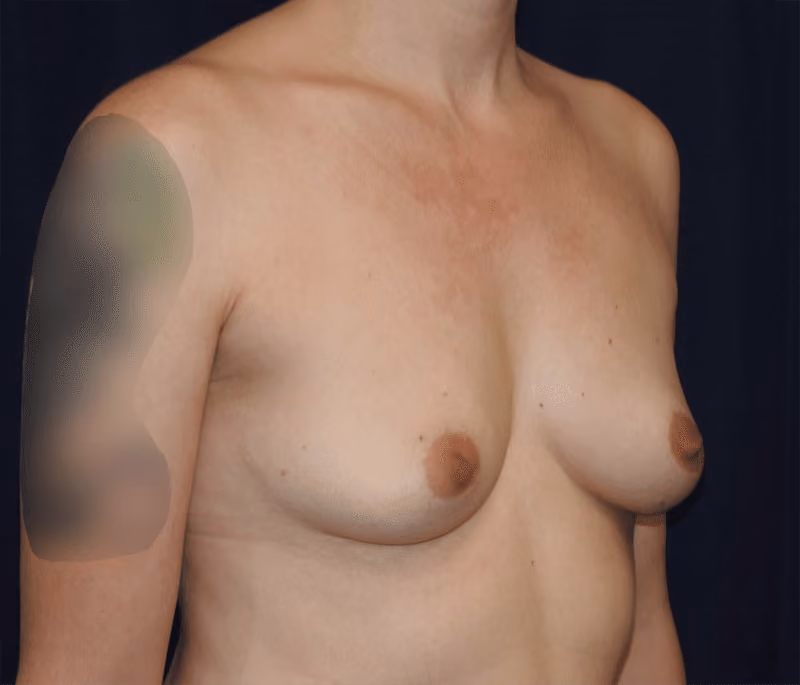 Breast Augmentation before and after, case 917 - Cool Springs Plastic Surgery