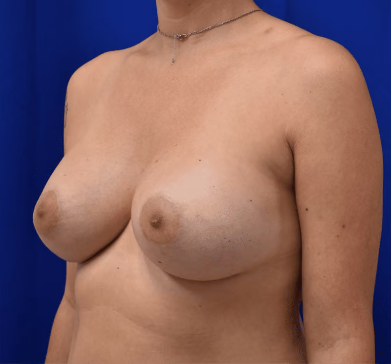 Breast Augmentation before and after, case 917 - Cool Springs Plastic Surgery