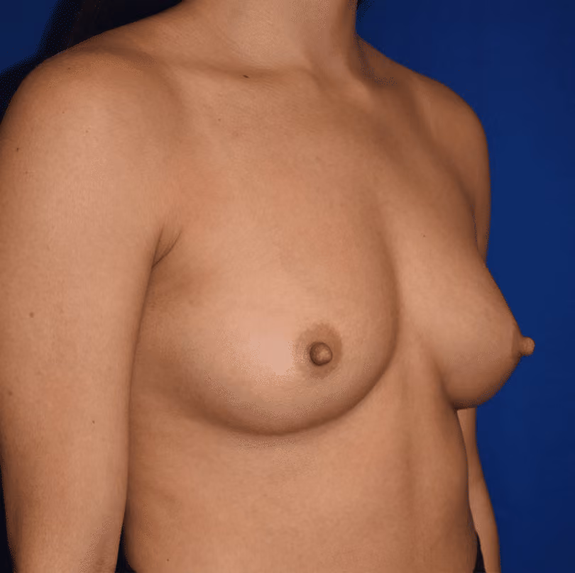 Breast Augmentation before and after, case 904 - Cool Springs Plastic Surgery