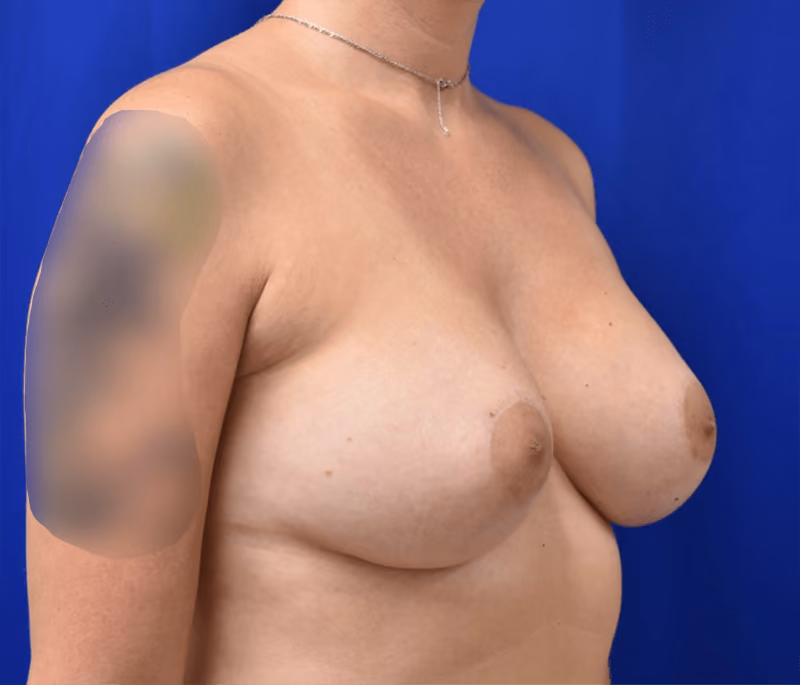Breast Augmentation before and after, case 917 - Cool Springs Plastic Surgery