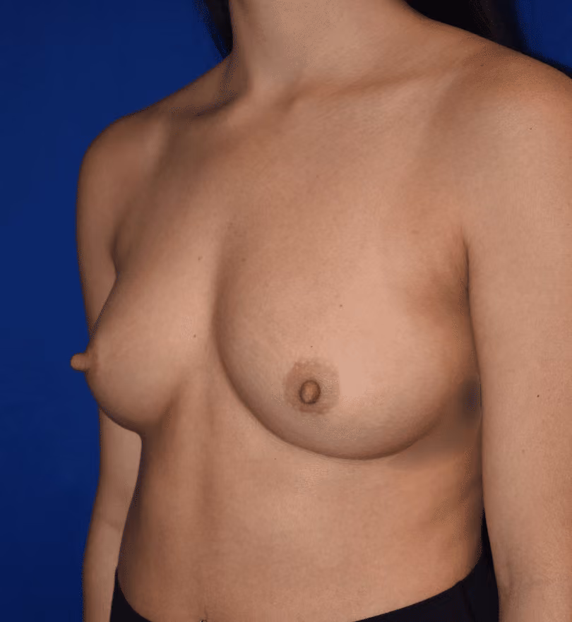 Breast Augmentation before and after, case 904 - Cool Springs Plastic Surgery