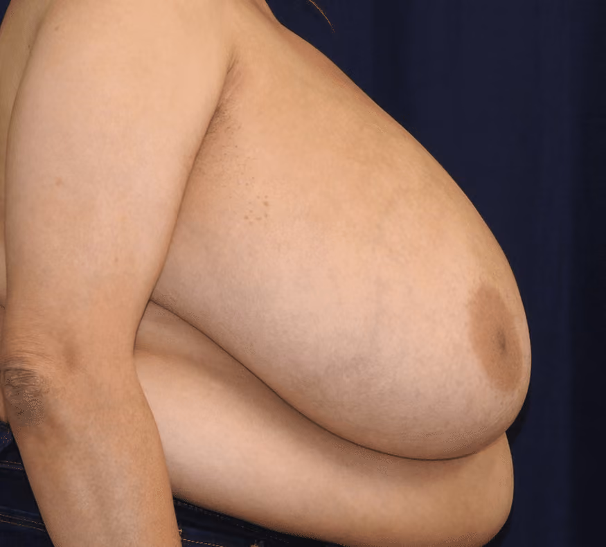 Breast Reduction before and after, case 878 - Cool Springs Plastic Surgery